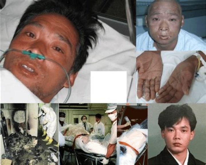 Hisashi Ouchi Radiation Photos: A Tragic Tale of Survival and Suffering