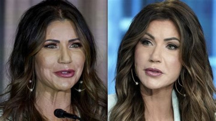 Kristi Noem's Cosmetic Surgery: A Comprehensive Overview