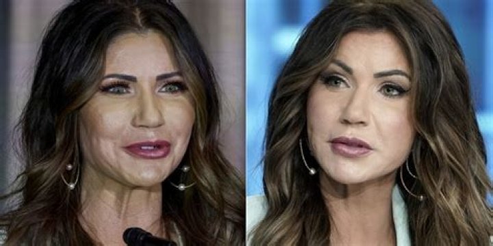 Kristi Noem Plastic Surgery Before After: An In-Depth Analysis